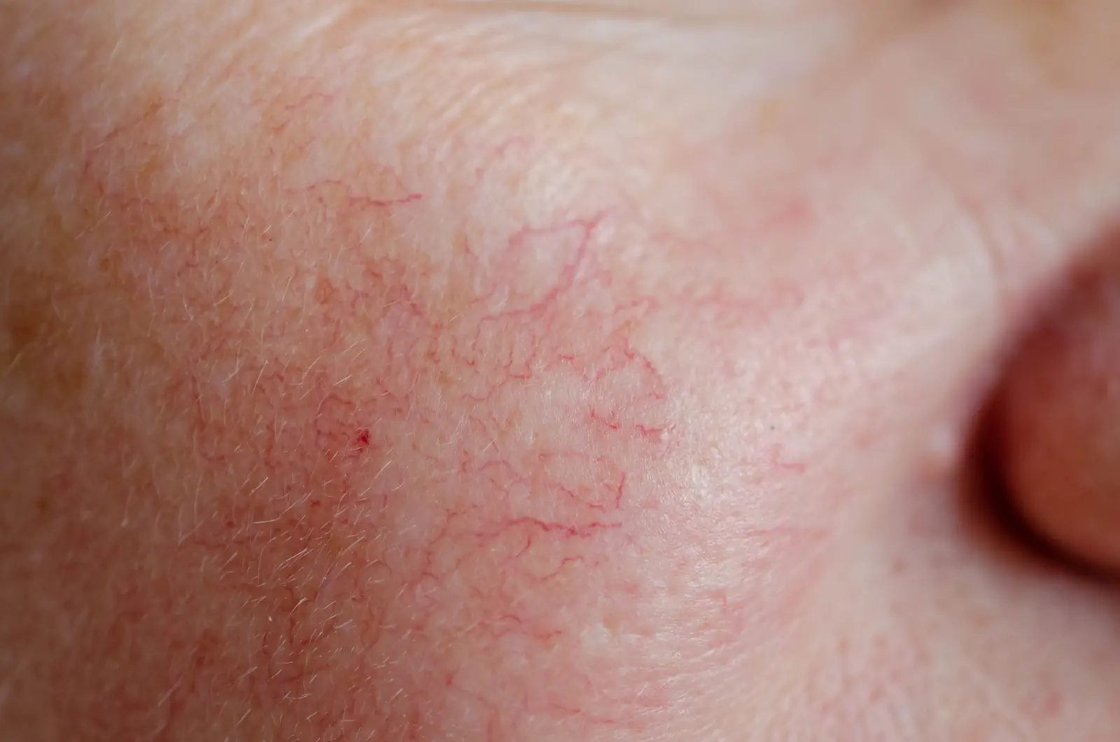 Close-up of facial spider veins and broken capillaries requiring laser treatment at Hamilton NJ vein clinic