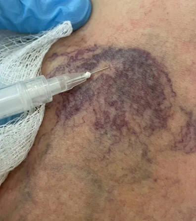 Before vein treatment