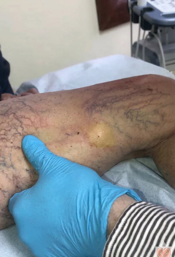 During spider vein sclerotherapy treatment