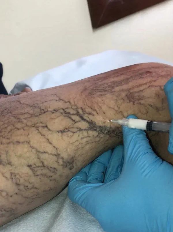 Before spider vein treatment